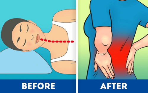 4. Sử dụng gối không phù hợp. Gối giúp bạn cảm thấy thoải mái, dễ ngủ nhưng hầu hết loại gối đều khiến đầu ở tư thế không tự nhiên, gây áp lực lên cổ và cột sống. Tư thế ngủ không phù hợp gây áp lực lớn lên cột sống, làm mất đường cong tự nhiên, lâu dần gây ra các cơn đau nhức lưng và một số bệnh lý về cột sống.