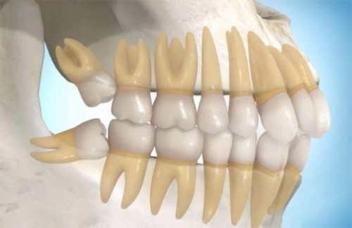 Tuỳ cơ địa mỗi người mà thời gian mọc răng khôn có thể kéo dài vài tháng, thậm chí vài năm mới mọc hết răng khôn. Ảnh: nhakhoaphuonganh.