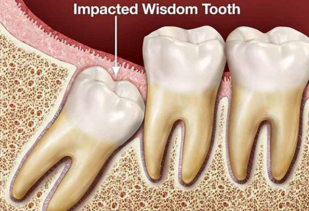 Từ năm 10 tuổi, răng khôn bắt đầu hình thành trong xương hàm và bắt đầu mọc ở độ tuổi 17-25. Ảnh: amazonaws.