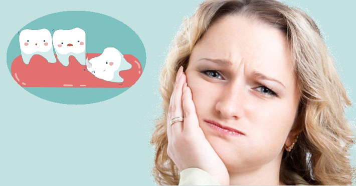 Răng khôn sẽ không mọc một lần là xong, mà mỗi lúc “nhú” ra một chút. Ảnh: nhakhoahanquoc.
