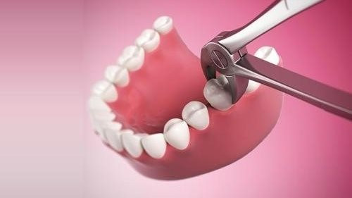 Các dạng mọc của răng khôn gồm: Răng khôn mọc lệch ngang, răng khôn mọc thẳng, răng khôn mọc lệch ngầm, lợi trùm răng khôn. Ảnh: khoahocdoisong.