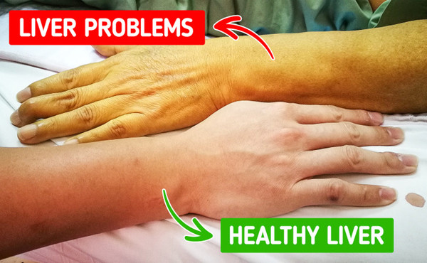 Vàng da. Người khỏe mạnh sẽ có làn da bóng khỏe, hồng hào. Do đó, khi da chuyển vàng, bạn cần hết sức cảnh giác bởi đây là dấu hiệu sức khỏe có vấn đề. (Ảnh BS, minh họa)
