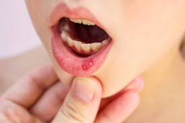 Đôi khi, nhiệt miệng có thể xuất hiện do thiếu vitamin B12.