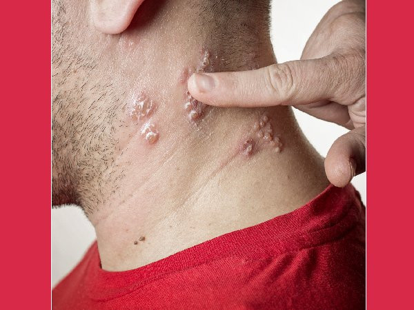 Nhiễm virus. Ngay cả bị nhiễm virus như zona thần kinh có thể gây đau ngực. Ở một vài trường hợp, thiếu máu đến các mô phổi cũng có thể gây ra các cơn đau ngực.