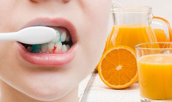 Nướu đỏ, chảy máu cũng là dấu hiệu phổ biến của thiếu vitamin C. Ảnh: express.