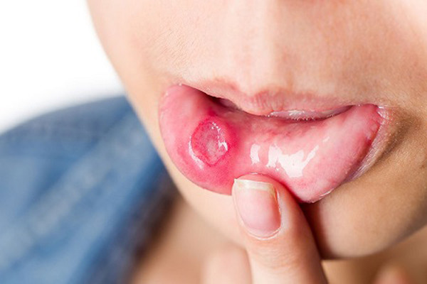 Loét miệng kéo dài. Niêm mạc miệng rất nhạy cảm nên thi thoảng sẽ xuất hiện tình trạng loét. May mắn thay, những vết loét thông thường thường tự lành trong 1-2 tuần. Ngược lại, nếu đối diện tình trạng thường xuyên loét miệng, loét miệng kéo dài hơn 2 tuần không khỏi thì cần đi khám để tìm hiểu nguyên nhân chính xác.