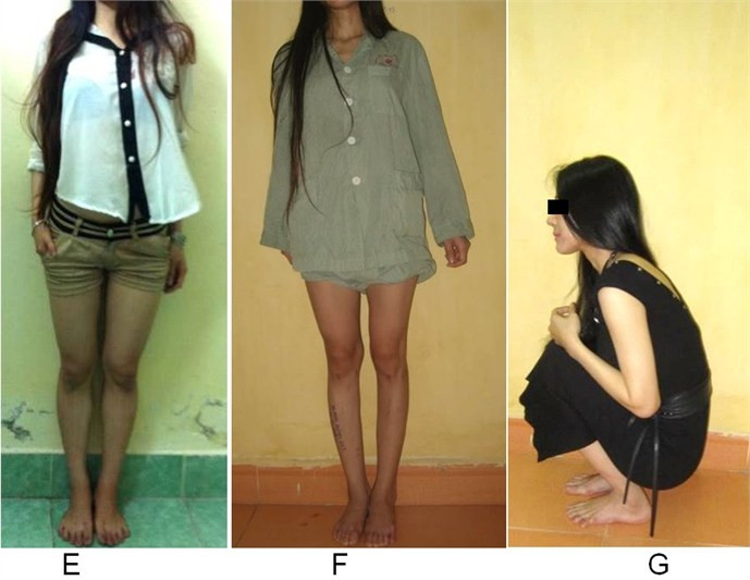 Sau khi kéo dài chân có yếu không? Theo PGS. TS. Lê Văn Đoàn, Viện trưởng Viện Chấn thương – Chỉnh hình, Bệnh viện TƯQĐ 108, phẫu thuật kéo dài chân không làm ảnh hưởng tới tuổi thọ của người thực hiện như nhiều người lầm tưởng. Tuy nhiên, sau khi kéo dài, các phần mềm (gân cơ, cơ, thần kinh, mạch máu, dây chằng) chưa đáp ứng kịp với tình huống mới.