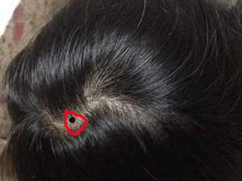 Nốt ruồi trên đỉnh đầu: Người có nốt ruồi trên đỉnh đầu thường là người do kiếp trước làm nhiều việc công đức nên kiếp này được quý nhân giúp đỡ, hơn nữa lại là người giàu có. Những người này khi gặp khó khăn, sẽ luôn có quý nhân chìa tay ra giúp đỡ họ. Ảnh: sohu.com.