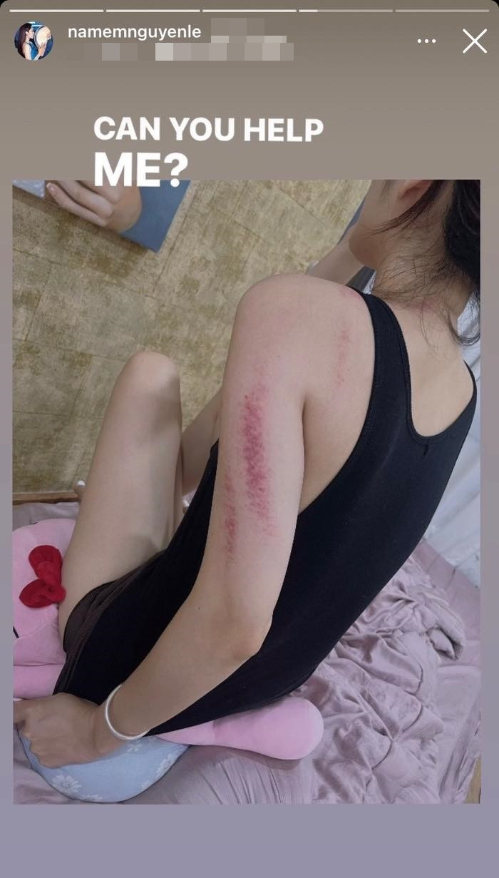 Mới đây, trên trang cá nhân, Nam Em đăng ảnh thân hình gầy gò với một số vết bầm tím ở cánh tay và bả vai khiến các fan của người đẹp bày tỏ sự quan tâm.