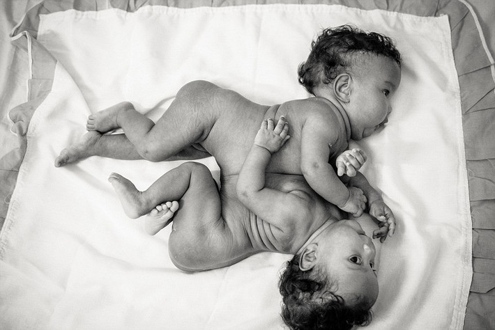 Maria Clara và Maria Eduarda Oliveira Santana bị dính liền phần bụng và có chung một lá gan.