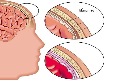 Tràn dịch dưới màng cứng. Hay gặp ở trẻ nhỏ và bú mẹ, đặc biệt trong trường hợp H.influenzae và phế cầu. Nghi ngờ khi sốt kéo dài, tái phát, ngủ lịm, hôn mê, co giật khu trú, vòng đầu tăng. Chẩn đoán nhờ siêu âm và scanner.