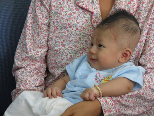 Viêm màng não mủ có thể để lại những di chứng nặng. Tuy nhiên không phải bé nào bị bệnh cũng sẽ bị di chứng. Khoảng 9% trẻ bị biến chứng có những vấn đề về nhân cách. 28% giảm hoặc mất thính lực, mù, rối loạn về nói, động kinh, chậm phát triển tinh thần vận động. 13% có di chứng mức độ nhẹ hơn.