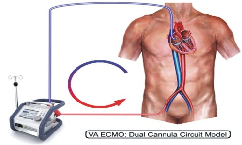 ECMO có 2 mode cơ bản là ECMO tĩnh mạch – động mạch (Venoarterial – VA ECMO