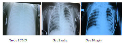 Những bệnh nhân bị suy hô hấp nặng và viêm cơ tim cấp nếu áp dụng phương pháp truyền thống nguy cơ tử vong hầu như 100%. ECMO được xem là biện pháp cứu cánh cuối cùng trong điều trị và hồi sức cấp cứu đối với những bệnh nhân mắc bệnh hiểm nghèo. Chi phí một màng lọc hiện nay khoảng 85 triệu đồng, sử dụng trong khoảng 14 ngày.