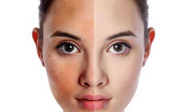 Da xỉn, mí mắt sưng. Thận hoạt động không hiệu quả khiến độc tố khó đào thải ra ngoài. Điều này dẫn đến việc natri sẽ được giữ lại, gây tình trạng ứ dịch, phù nề. Do vậy, phụ nữ nếu thấy da ngày càng xỉn màu, mí mắt sưng (đặc biệt thời điểm thức dậy buổi sáng) thì cần cảnh giác tình trạng thận yếu.