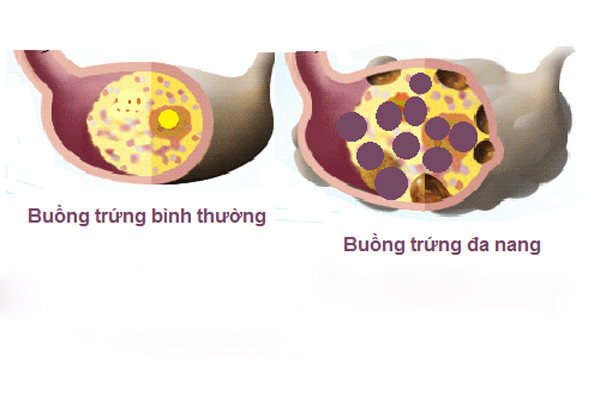 Những hooc môn có trong viên ngừa thai sẽ giúp phụ nữ tạo lại cân bằng, ức chế sự kích thích buồng trứng bởi Gonadotropin, nhờ đó làm giảm sản xuất Androgen. Thuốc làm giảm nồng độ LH và thành phần Estrogen kích thích sản xuất hooc môn giới tính SHBG tại gan, nhờ đó làm giảm androgen có hoạt tính.