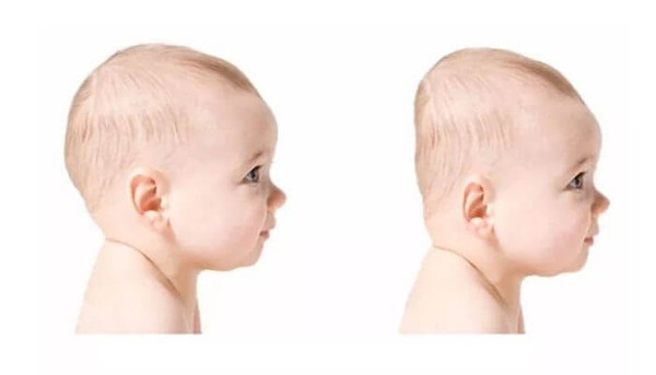 Trẻ sơ sinh thường dành phần lớn thời gian trong ngày cho việc ngủ. Nhiều mẹ thấy trẻ ngủ sâu nên không điều chỉnh tư thế cho con. Vậy nhưng, duy trì một tư thế ngủ suốt thời gian dài có thể gây biến dạng đầu trẻ, dẫn đến hội chứng đầu phẳng ở trẻ em. (Ảnh: Sohu, minh họa)