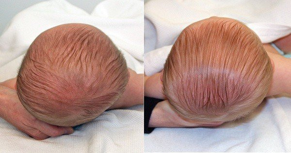 Được biết, hội chứng đầu phẳng là tình trạng hình dạng đầu không đối xứng, méo do tác động của lực làm biến dạng hộp sọ. Trẻ mắc hội chứng đầu phẳng nhiều trong giai đoạn sáu tuần tuổi, tăng lên tối đa khi được bốn tháng rồi sau đó giảm dần trong hai năm.