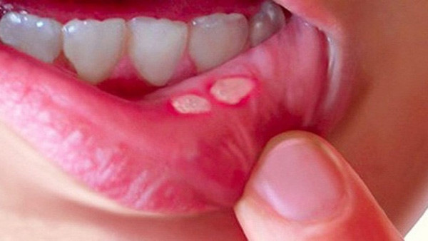 Trái lại, những người nóng trong, táo bón, loét miệng nên tận dụng vỏ gừng để pha trà uống. Tuy nhiên, bạn cần phải chú ý đến liều lượng, không nên uống quá nhiều, liên tục tránh gây tổn thương dạ dày.