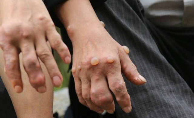 10. Nổi u cục không rõ nguyên nhân. Các loại u, cục sờ thấy được qua da thường là triệu chứng của bệnh ung thư vú, ung thư dương vật, ung thư hạch và ung thư tế bào mềm trong cơ thể.