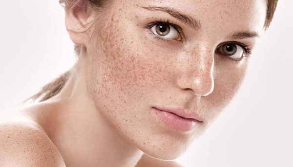 1. Nám da: Nám thường xuất hiện trên da mặt, đặc biệt vị trí gần xương gò má. Nám có màu nâu xám hoặc nâu đen, kích thước to nhỏ khác nhau, có viền, không gây đau ngứa. Nám không đơn thuần là phần da đổi màu, nó còn là dấu hiệu cơ thể nhiều độc tố cần hết sức quan tâm. (Ảnh minh họa)
