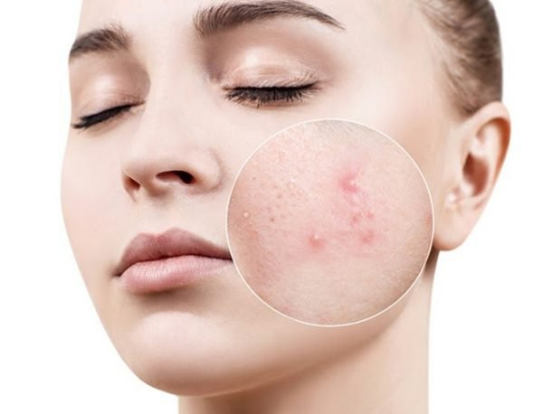 3. Mụn: Tây y cho rằng mụn trứng cá chủ yếu liên quan đến rối loạn nội tiết. Trong khi đó, Trung y cho rằng mụn trứng cá bắt nguồn từ chế độ ăn nhiều chất béo, đồ ngọt, dầu mỡ, cay nóng, tích nhiệt ở tỳ vị, ẩm thấp nội sinh.