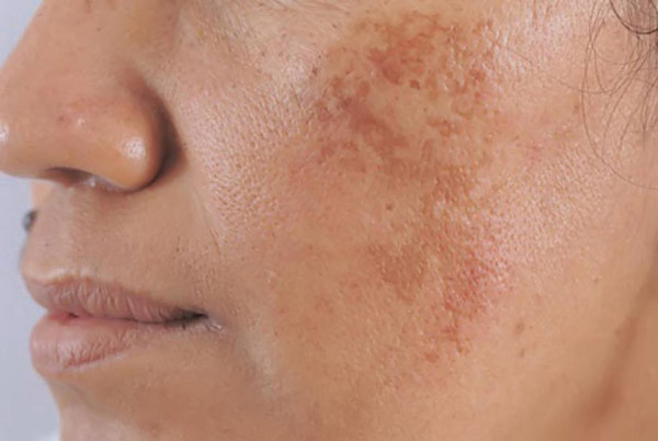 Trung y tin rằng, lượng chloasma trong cơ thể có liên quan mật thiết đến tình trạng nhiễm độc trong cơ thể. Những người tâm trạng không tốt, dễ cáu gắt thường bị gan khí ngưng trệ, huyết ứ làm tắc nghẽn kinh mạch khiến khí huyết không thông lên mặt được. Độc tố không đào thải ra ngoài, cuối cùng hình thành sắc tố.