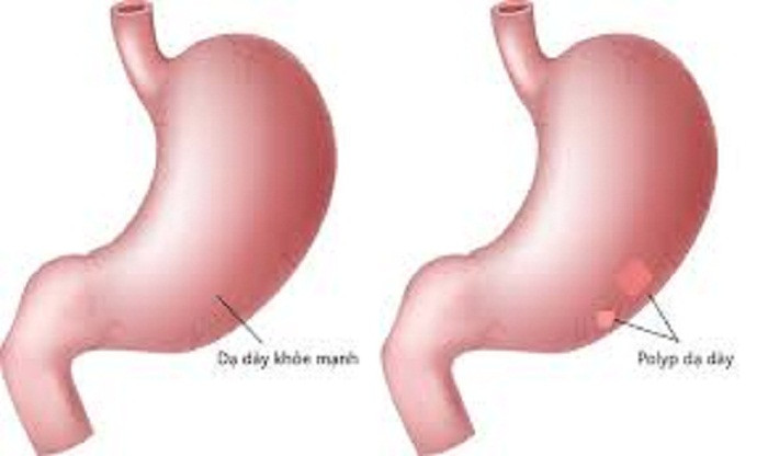 Polyp dạ dày. Giống như polyp đại tràng, polyp dạ dày có nguy cơ chuyển thành ác tính. Ở đó, polyp dạ dày là những khối u lồi có hình dạng khác nhau (dạng elip hoặc hình tròn), có cuống, đôi khi còn được gọi là khối u. Khối u này được hình thành do sự tăng sinh quá mức của niêm mạc dạ dày.