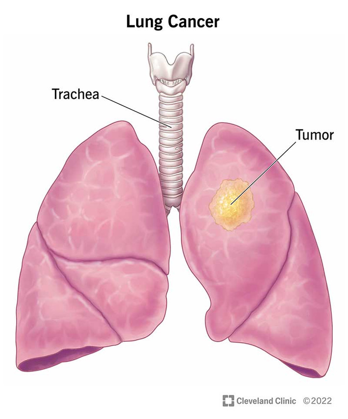 Giải thích tình trạng này, chuyên gia cho rằng ung thư ảnh hưởng đến hệ miễn dịch hoặc di căn đến não. Ngoài ra, tình trạng tăng canxi huyết cũng có thể gây lú lẫn, tư duy lộn xộn, thậm chí trầm cảm. Ảnh: CC.