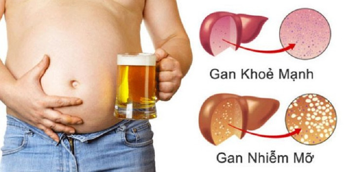 Gan nhiễm mỡ là hiện tượng khi lượng mỡ tích tụ trong gan chiếm quá 5% trọng lượng của gan. Ảnh: vietnamembassy.