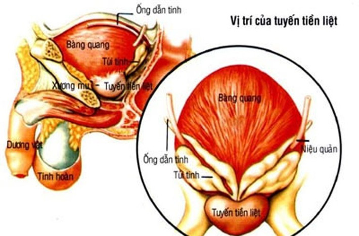 Ung thư tuyến tiền liệt. Bằng cách chú ý những dấu hiệu nhỏ tưởng chừng không liên quan, nam giới vẫn có thể phát hiện kịp thời và chẩn đoán bệnh ung thư tiền liệt tuyến một cách sớm nhất. Những dấu hiệu sớm được phát hiện như, khó khăn tiểu tiện, giảm lực trong dòng nước tiểu, có máu trong nước tiểu hay trong tinh dịch, sưng ở chân và khó chịu ở vùng xương chậu.