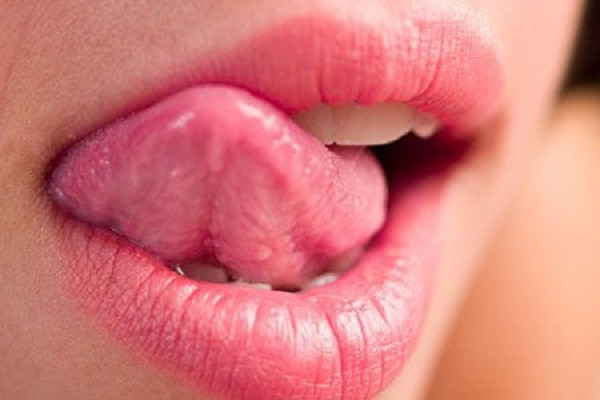 Cục u trên lưỡi. Phía cạnh lưỡi tiếp xúc với răng có thể phát triển các khối u. Nếu các khối u này không được điều trị sẽ lớn dần và loét ra. Cục u có thể màu đỏ hoặc trắng, gây khó khăn khi ăn, nhai thậm chí là uống nước.