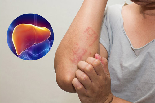 Gan đóng vai trò quan trọng với sức khỏe tổng thể. Điều đáng lưu ý, gan không có dây thần kinh cảm giác đau nên dù có bất thường cũng khó phát hiện. Để bảo vệ chức năng gan, chuyên gia khuyến nghị bỏ những thói quen hại gan trên.