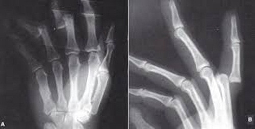 3 năm trước, cô gái được chẩn đoán mắc hội chứng Ehlers Danlos (rối loạn di truyền mô liên kết) khiến xương luôn bị trật khỏi khớp rất nhiều lần trong ngày.
