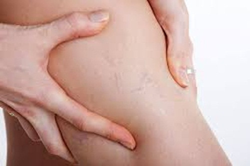 Suy tĩnh mạch. Các đường suy tĩnh mạch xuất hiện như các đường màu tím hay xanh trên chân trong quá trình mang thai. Nó gây ra bởi hiện tượng xung huyết, có thể gây đau đớn hoặc khó chịu. Để ngăn ngừa, các mẹ bầu hãy ăn thực phẩm nhiều vitamin C và giữ trọng lượng ở mức ổn định.