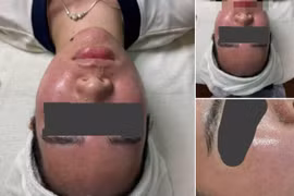 Người phụ nữ viêm da bội nhiễm nặng vì dùng kem dưỡng trắng mua trên mạng