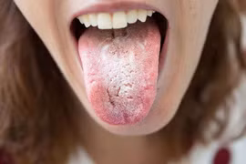Nấm miệng họng do Candida: Đừng chủ quan với mảng trắng bất thường