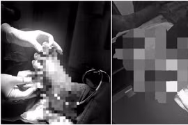 Nối thành công ca đứt rời bàn chân ở Quảng Trị