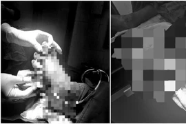 Nối thành công ca đứt rời bàn chân ở Quảng Trị