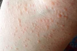 WHO cảnh báo: Nửa dân số thế giới có thể mắc dị ứng vào 2050