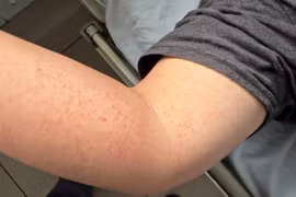 Bệnh viện Bạch Mai cảnh báo dịch sốt xuất huyết nghiêm trọng tại Hà Nội