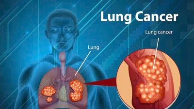 Ung thư phổi, ung thư đại trực tràng ngày càng trẻ hoá