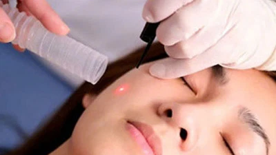 Hướng dẫn tẩy nốt ruồi bằng laser an toàn, hiệu quả cao