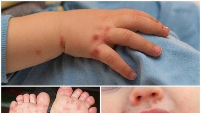Đừng chủ quan bệnh tay chân miệng khi trời mưa ẩm ướt