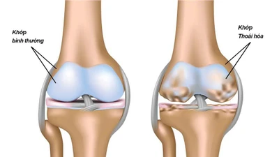 Bí quyết giảm đau xương khớp hiệu quả