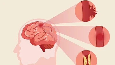 Phục hồi chức năng sau tai biến mạch máu não