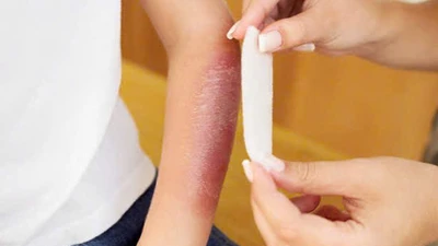 Cách sơ cứu, điều trị bỏng hiệu quả