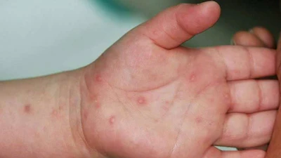 Phòng tránh bệnh tay chân miệng mùa cao điểm