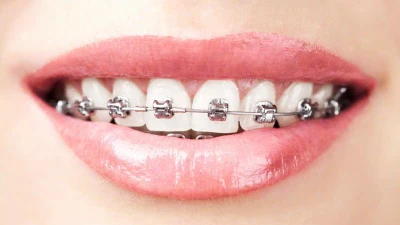 Sai lầm khi niềng răng, cách khắc phục hiệu quả