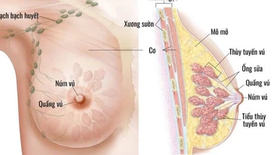 Ung thư vú ở phụ nữ trẻ tuổi, mối lo ngày càng tăng